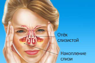 Симптомы гайморита