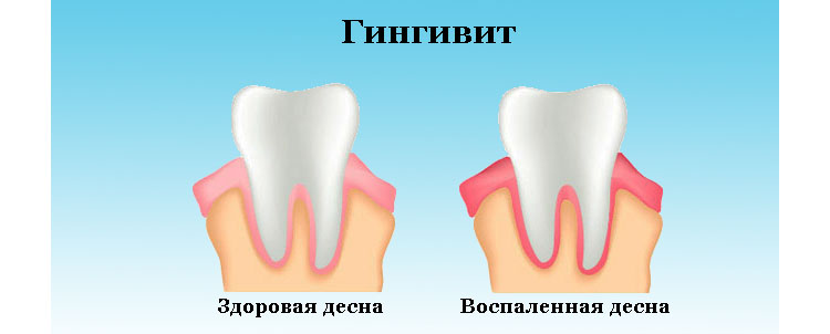 Гингивит зубов