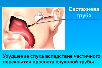 Перекрытие просвета слуховой трубы