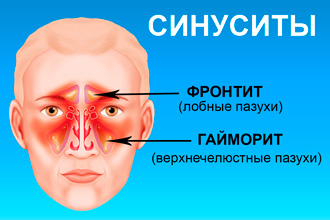 Синуситы