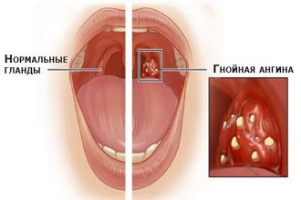 Гнойная ангина