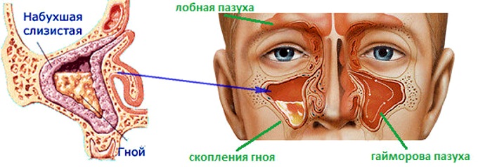 Виды гнойного гайморита