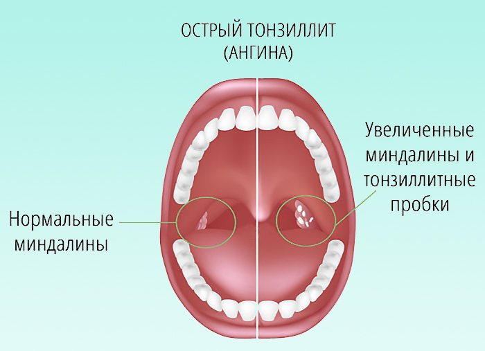 Миндалины в норме и гнойным налетом