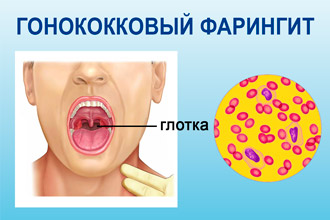 Гонорейный фарингит