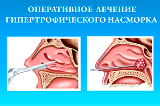 Оперативное лечение гипертрофического насморка