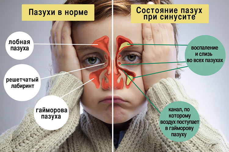 Симптомы гайморита
