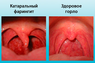 Катаральный фарингит
