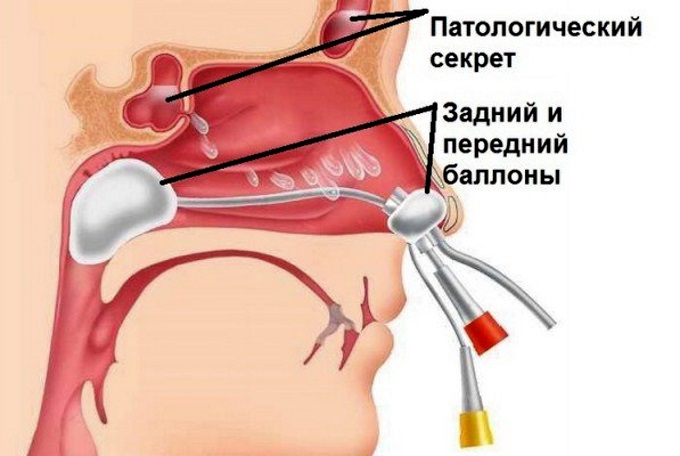 Промывание пазух носа при хроническом синусите