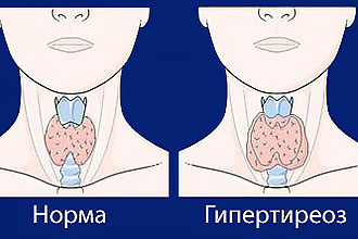 Противопоказания