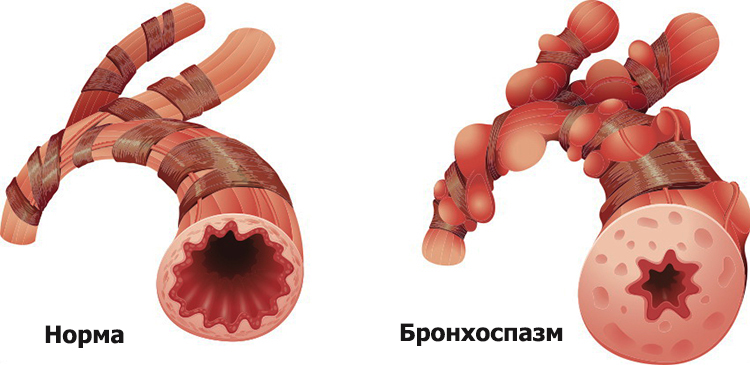 Спазм бронхов