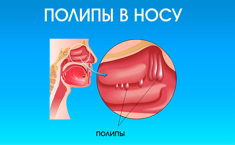 Назальный полипоз