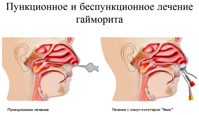 Лечение синусита