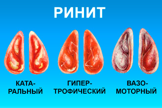 Ринит