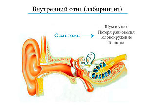 Внутренний отит