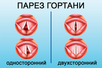 Парез голосовых связок