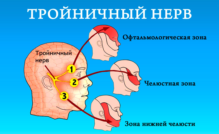 Невралгия тройничного нерва