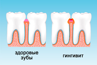 Гингивит зубов