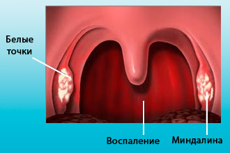Как определить фарингит 