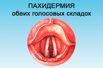 Пахидермия обеих голосовых складок