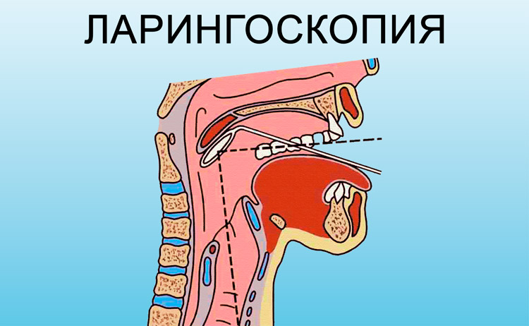 Проведение ларингоскопии