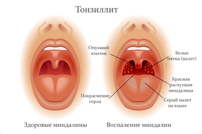 Как лечить казеозные пробки при тонзиллите