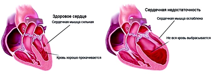 Симптомы кашля при сердечной недостаточности