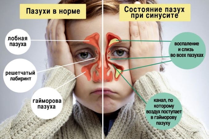 Как выявить синусит у детей