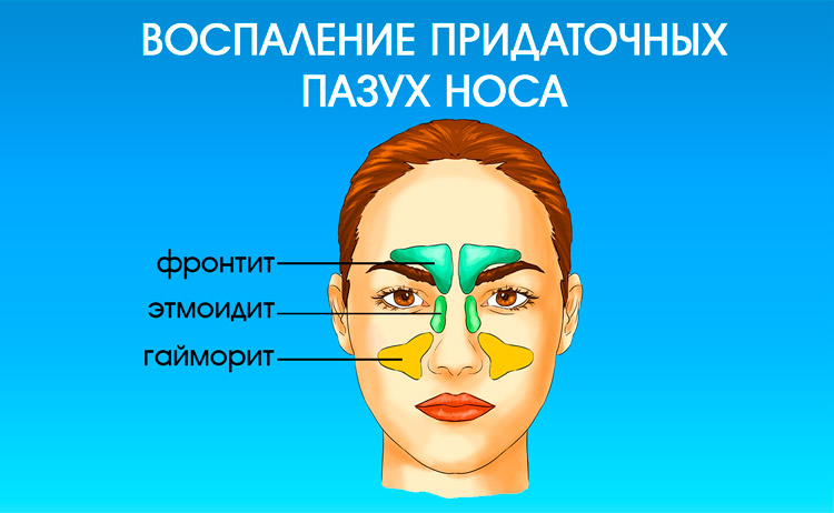Воспаление придаточных пазух носа