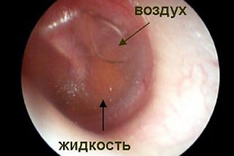 Тубоотит
