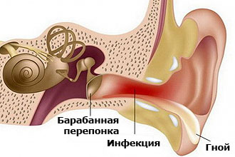 Причины гноетечения
