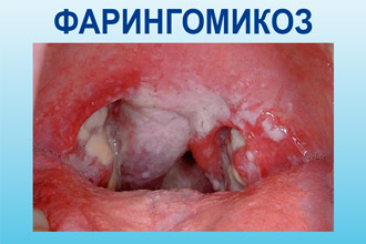 Грибковое воспаление глотки