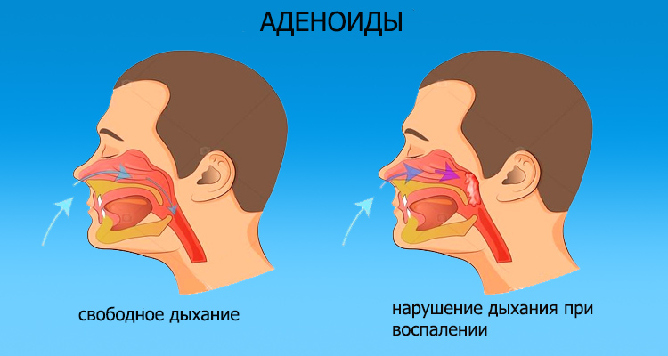Инфекционная болезнь